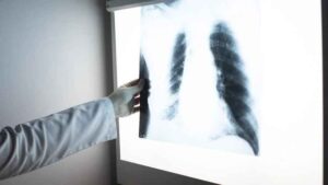 Dünyada erkeklerde en sık akciğer, kadınlarda da meme kanseri görülüyor