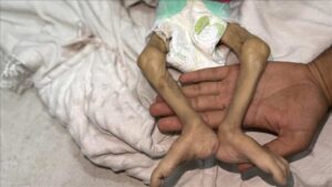 İsrail'in açlık ve kıtlığı dayattığı Gazze Şeridi'nde son 24 saatte 1'i çocuk 14 Filistinli açlıktan hayatını kaybetti